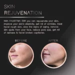 faustina-3sr-skin-rejuvenation-before-after.webp