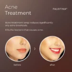 FAUSTINA IPL Acne Clearance lamp with before and after example of acne-prone skin